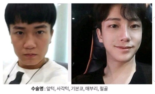 남자성형 전후 레전드 ㄷㄷ | 인스티즈
