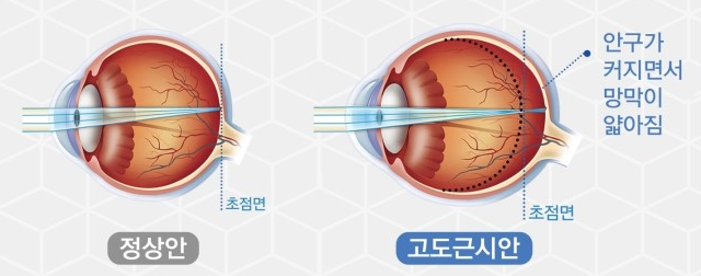 고도근시인 사람들이 주기적으로 안과에 가야하는 이유....jpg | 인스티즈
