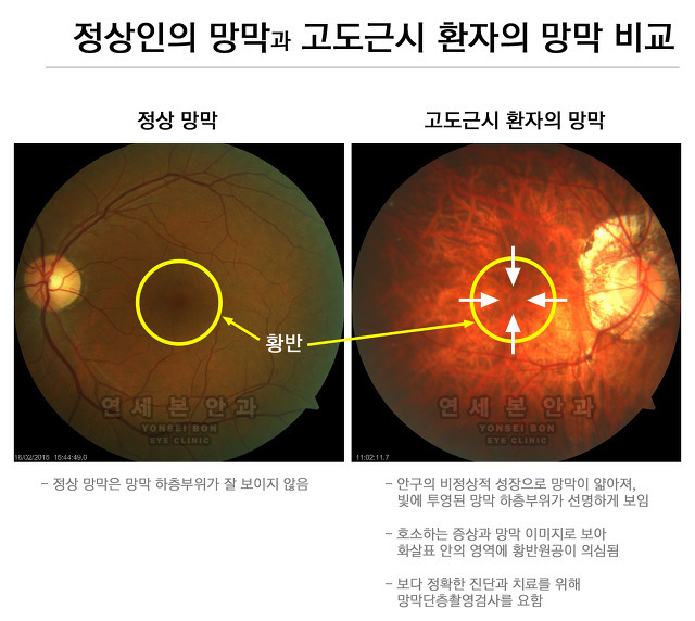 고도근시인 사람들이 주기적으로 안과에 가야하는 이유....jpg | 인스티즈