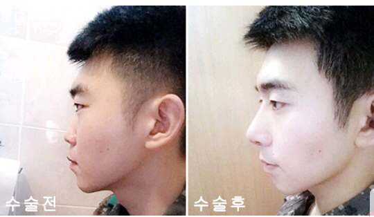 남자성형 전후 레전드 ㄷㄷ | 인스티즈