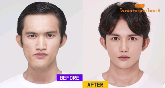남자성형 전후 레전드 ㄷㄷ | 인스티즈