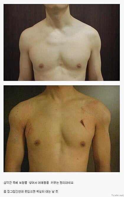남자 어깨성형.jpg | 인스티즈