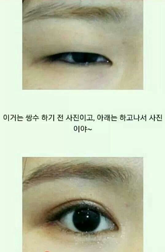 쌍커풀 수술 비포에프터 레전드.jpg | 인스티즈