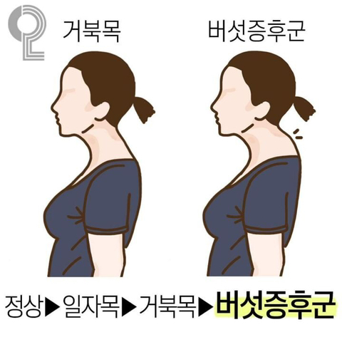 거북목 교정 빨리 안하면 생기는 증후군 | 인스티즈