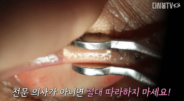 눈 기름샘 마이봄샘 피지 짜기.gif | 인스티즈
