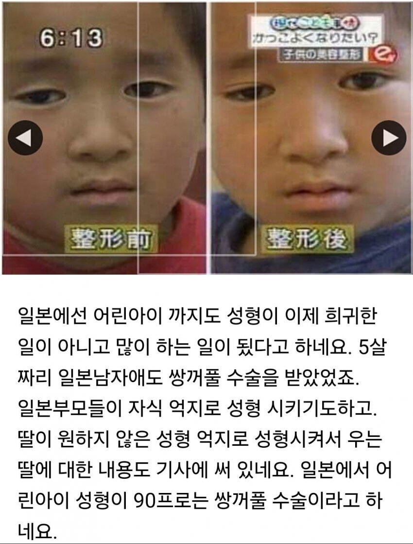 쌍꺼풀 성형수술 받은 일본 초등학생.jpg | 인스티즈