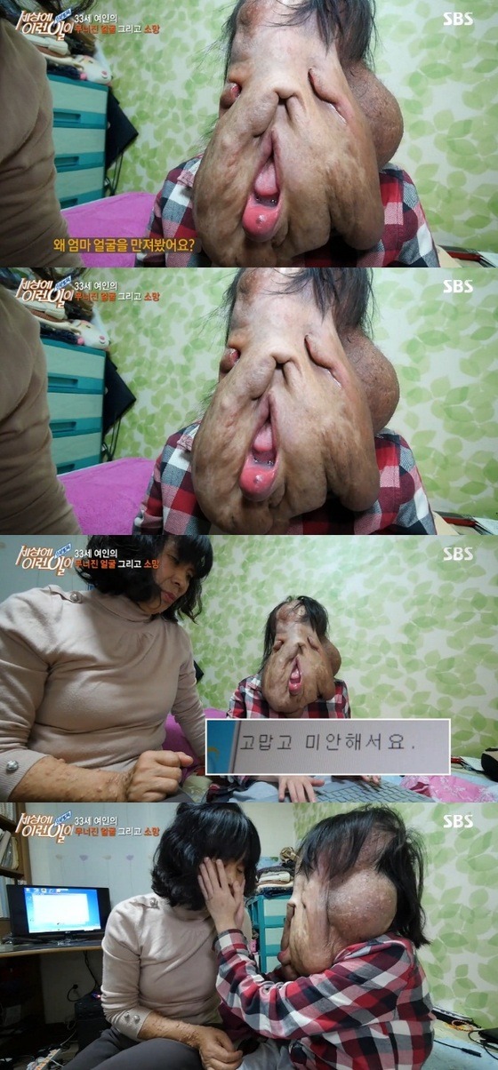 '세상에 이런일이', 신경섬유종 여인의 무너진 얼굴 | 인스티즈