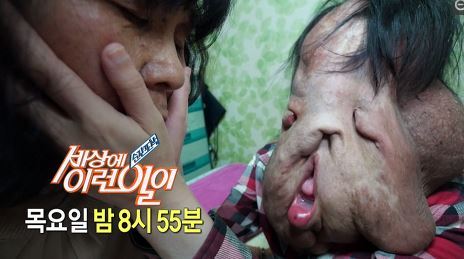 '세상에 이런일이', 신경섬유종 여인의 무너진 얼굴 | 인스티즈