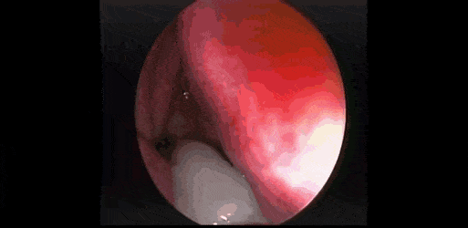 [혐주의] 콧속에 있는 거대 콧물 덩어리 석션으로 꺼내는 짤.gif | 인스티즈