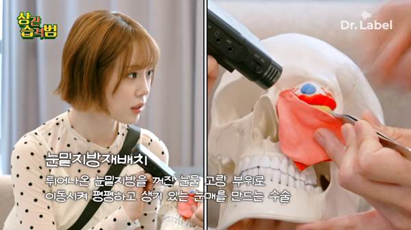 요즘 나이 있는 사람들이 한다는 수술.jpg | 인스티즈