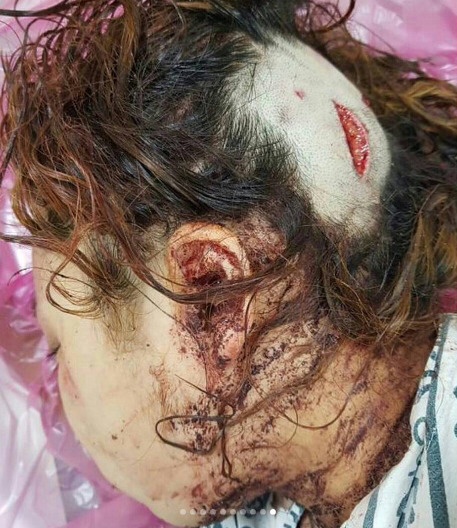 [사진주의] 부상여중생 폭행사건 경찰 관계자 망언 | 인스티즈