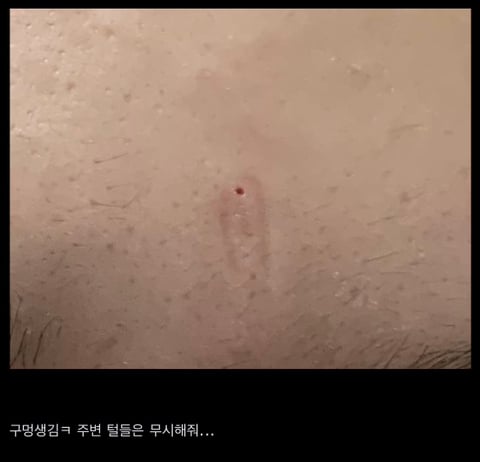 와 이마 중간에 여드름 뽑았는데 구멍 생겼어 | 인스티즈