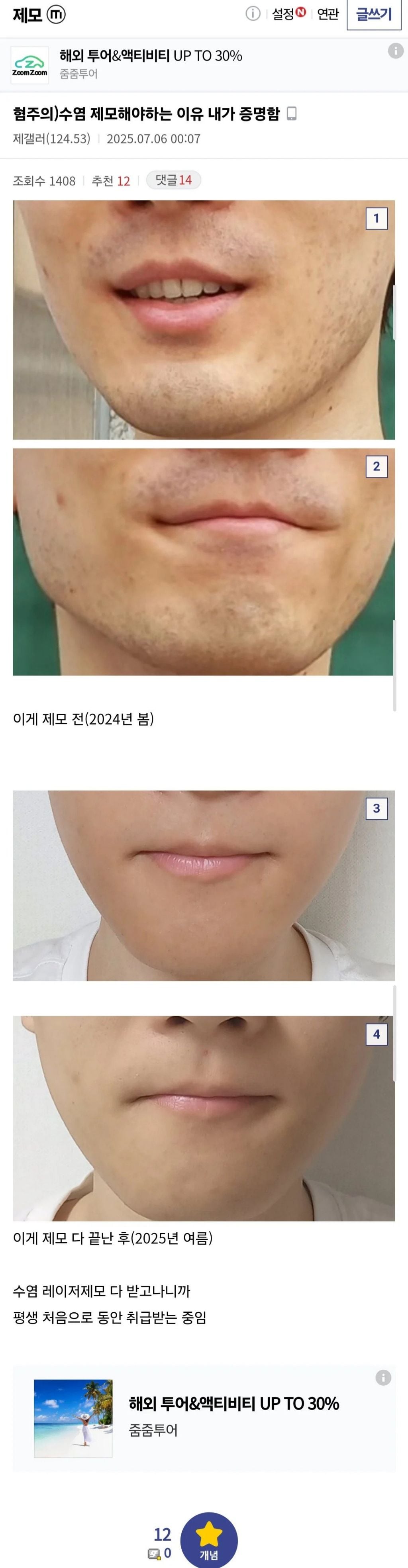 수염 레이저 제모해야하는 이유 알려주는 디시인.jpg | 인스티즈
