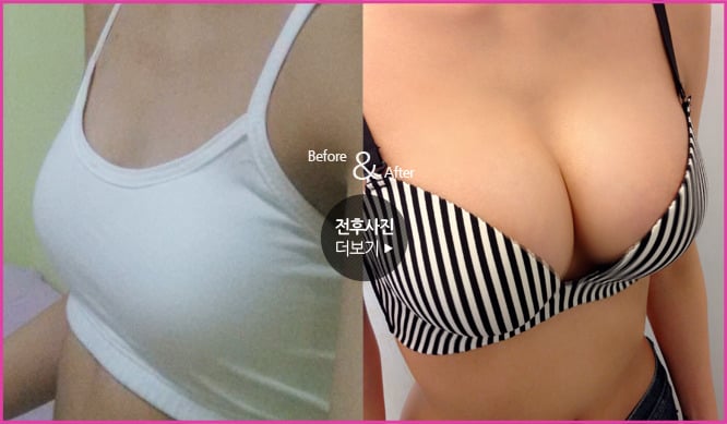성형외과 종사자들이 말하는 부작용 위험높은 수술 쓰리톱 (약혐주의) | 인스티즈