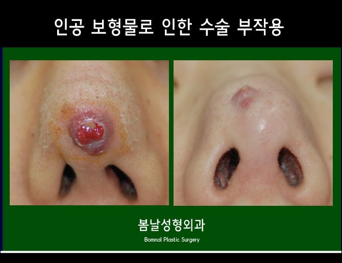 성형외과 종사자들이 말하는 부작용 위험높은 수술 쓰리톱 (약혐주의) | 인스티즈