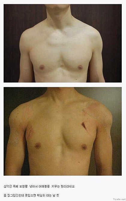 남자 어깨성형.jpg | 인스티즈