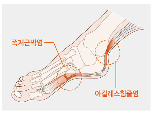 일상 정말 괴롭다는 발 병 투톱 | 인스티즈