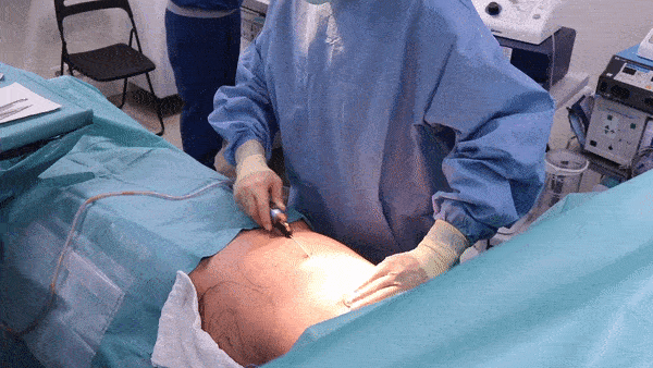 (약혐주의) 지방흡입 하는 방법.gif | 인스티즈