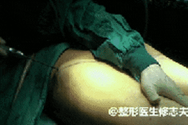 (약혐주의) 지방흡입 하는 방법.gif | 인스티즈