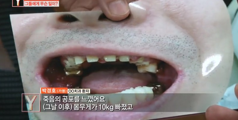 [궁금한이야기] 같은 치과 의사들도 충격받았다는 진료사진.jpg | 인스티즈