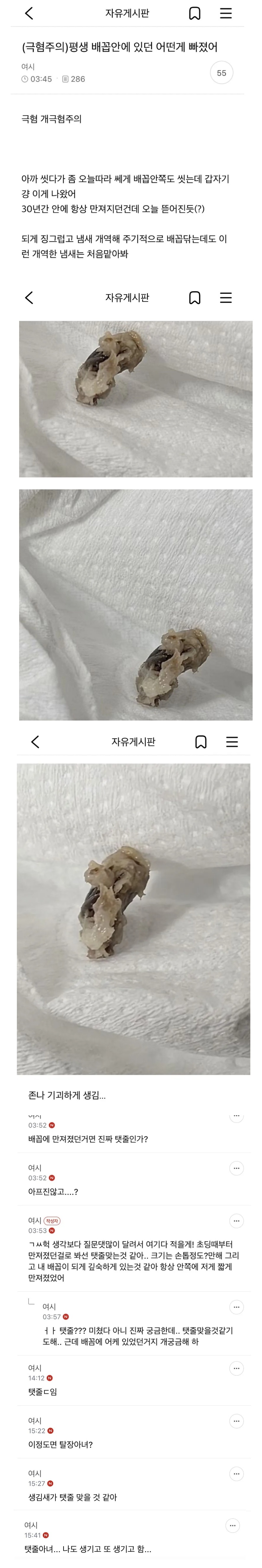 뱃속에 뭔가가 30년만에 빠짐 ㅎㅇㅈㅇ | 인스티즈
