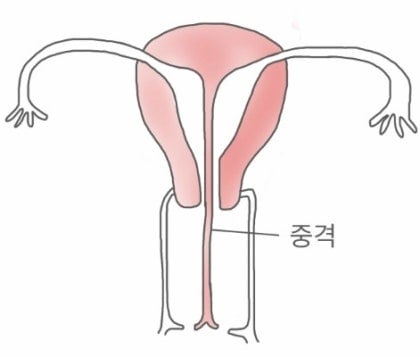 들어는 봤나 "중복자궁", 여성의 n%가 갖고있다는 자궁기형 | 인스티즈