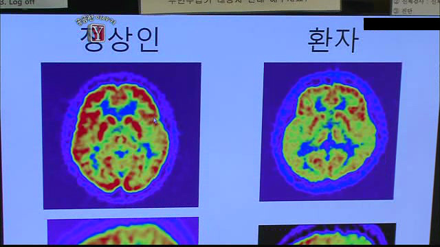 궁금한 이야기Y 서른살 청년의 알츠하이머.. | 인스티즈