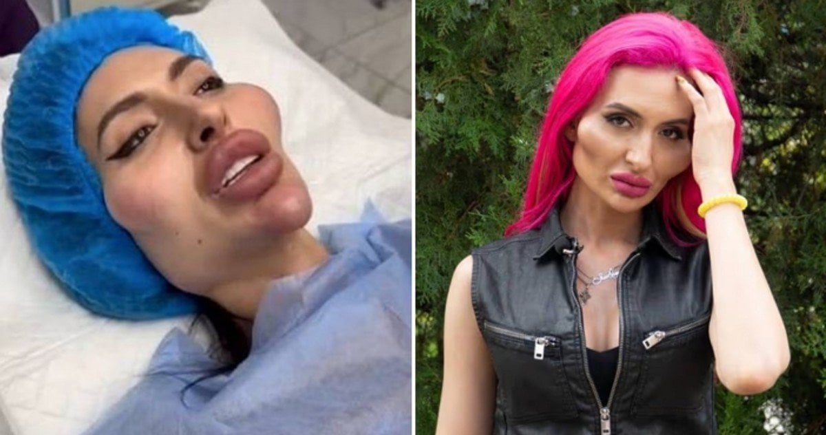 '세계서 가장 큰 볼' 포기... 10년 채운 필러 다 녹이는 모델, 뜻밖의 이유 | 인스티즈