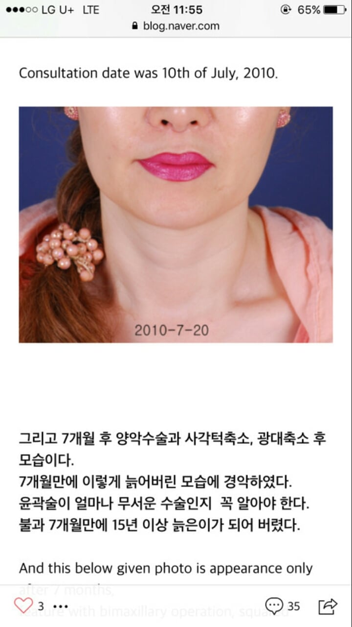 의사가 말해주는 안면윤곽수술 7개월 후 살처짐 | 인스티즈