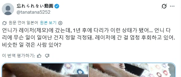 레이저 제모를 한 어느 여성에게 일어난 부작용 | 인스티즈