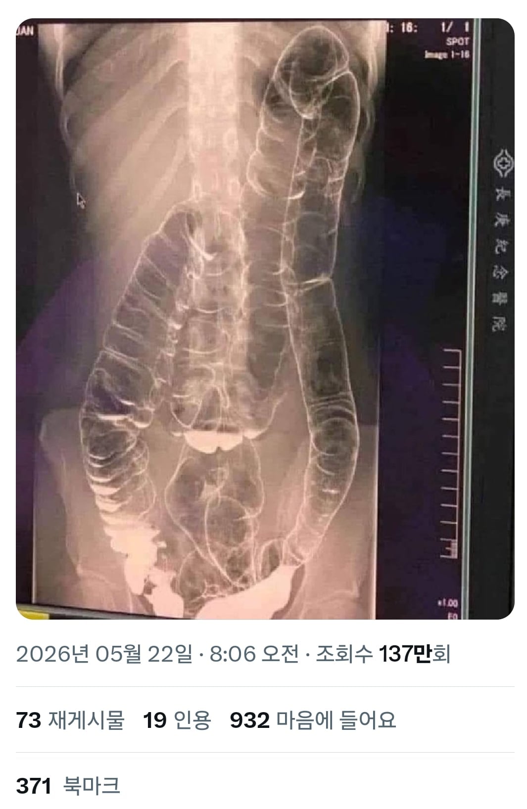 변비가 무서운 이유.jpg | 인스티즈