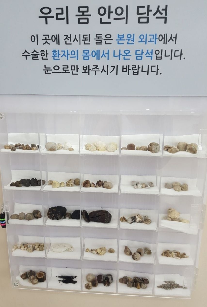 병원에 전시된 실제 환자들 몸에서 나온 담석들 | 인스티즈