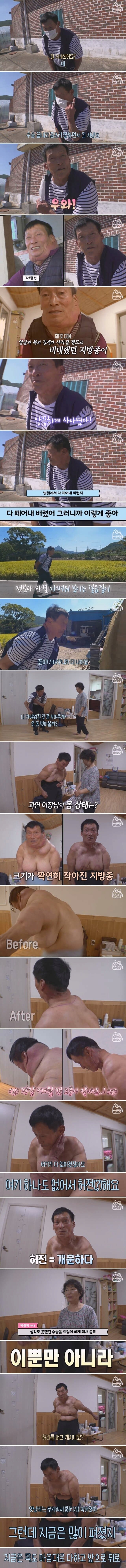 29년 만에 지방종 7kg 없앤 남자 | 인스티즈