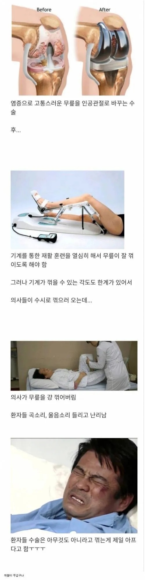 인공관절 수술 후, 환자들 최고의 고통 | 인스티즈