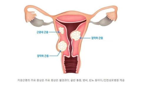 요즘 2030여성들에게 급증하고 있다는 종양.jpg | 인스티즈