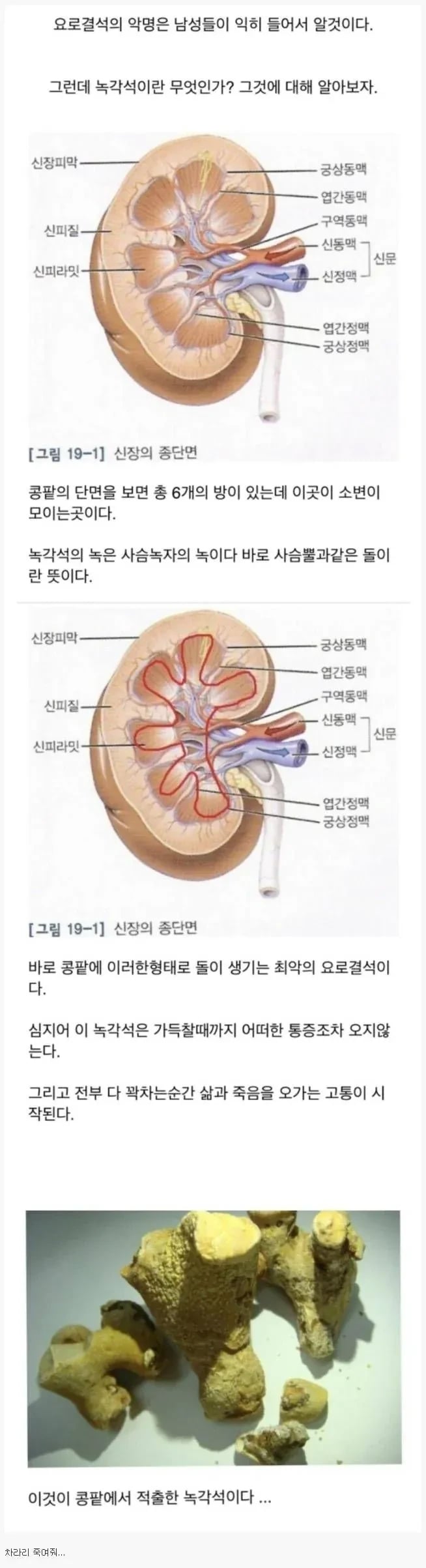 요로결석 중 최악 | 인스티즈