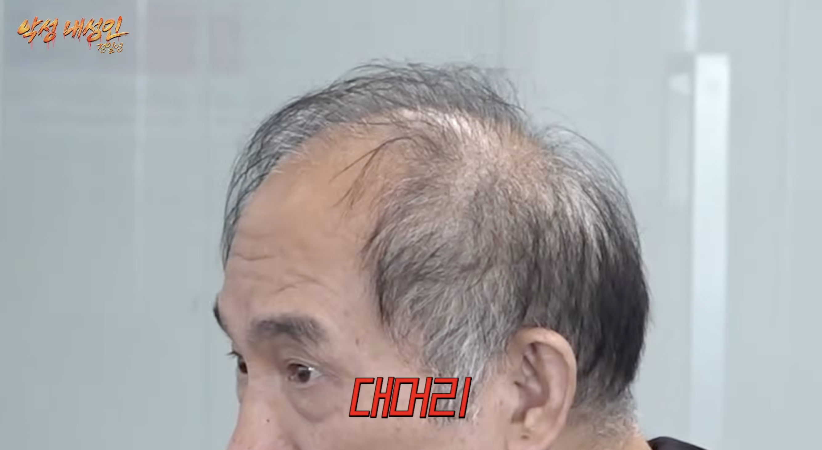 머리 심어도 자꾸 빠진다는 대머리 연예인 지망생.jpg | 인스티즈