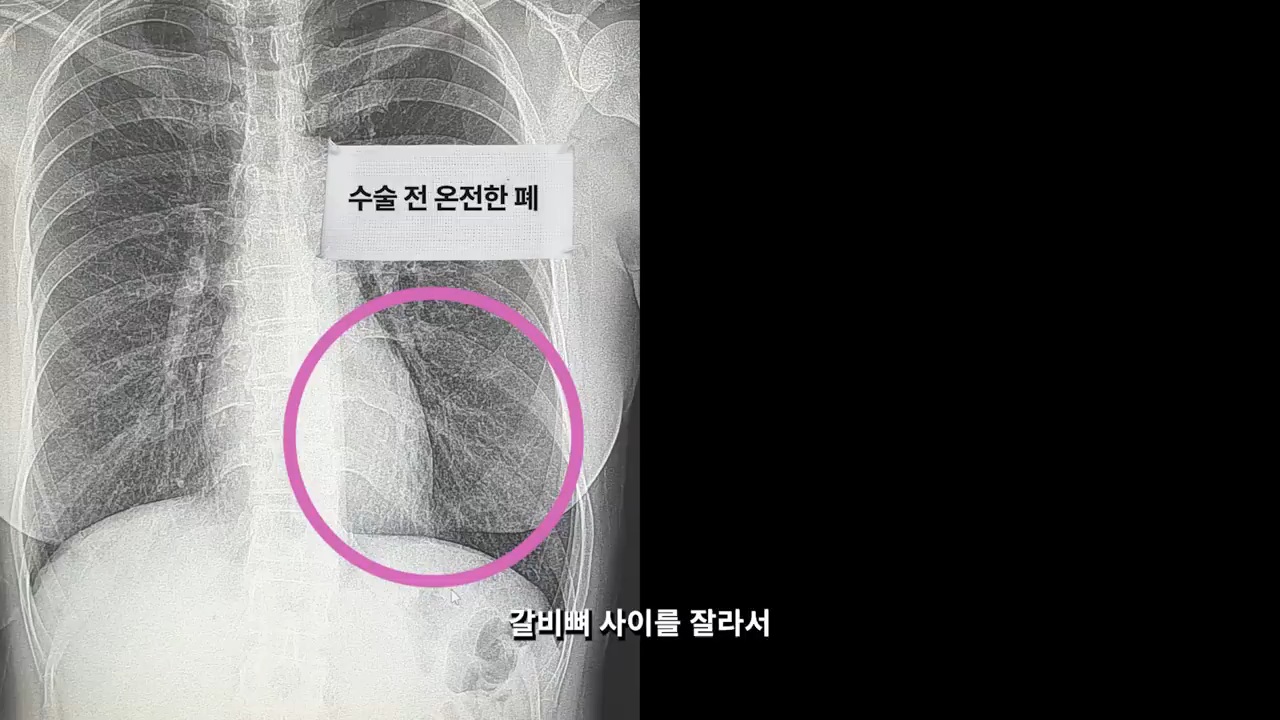 암 투병 6년 차, 5번째 추적검사를 앞둔 이혜영 | 인스티즈
