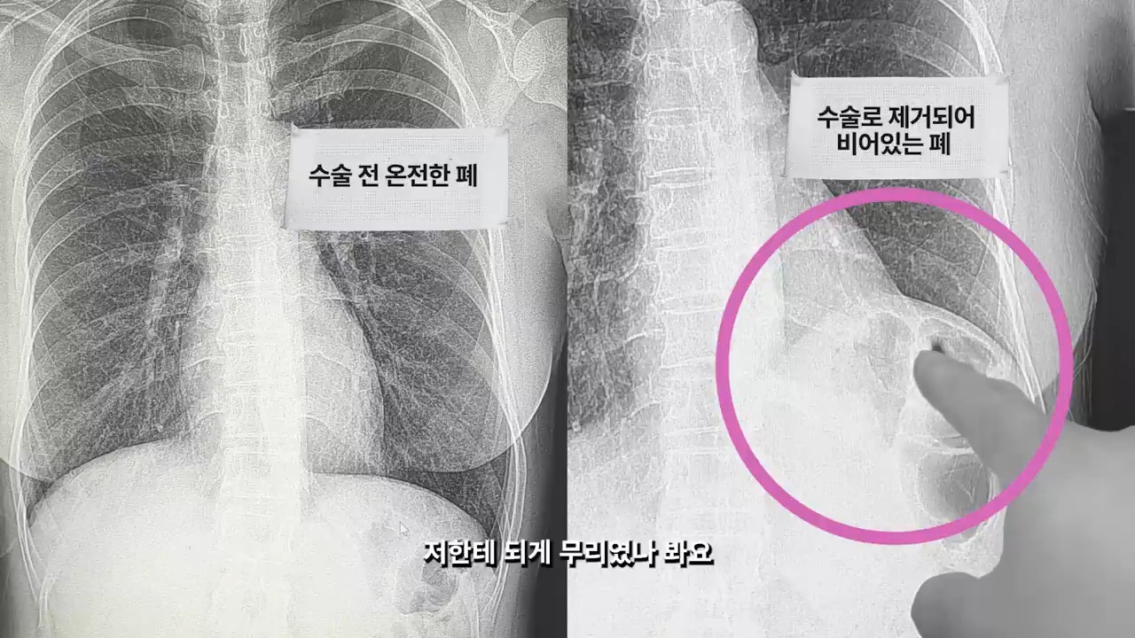 암 투병 6년 차, 5번째 추적검사를 앞둔 이혜영 | 인스티즈