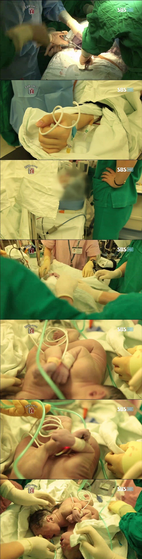 궁금한이야기 Y 샴쌍둥이 이야기 | 인스티즈
