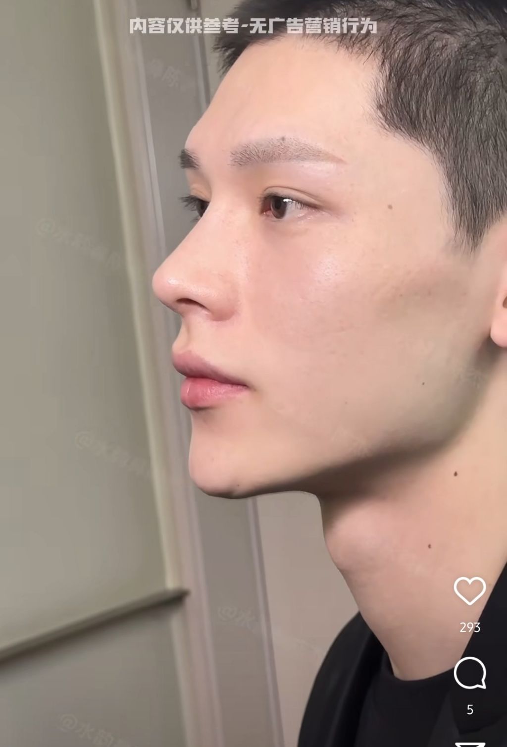 남자 코수술 레전드 | 인스티즈