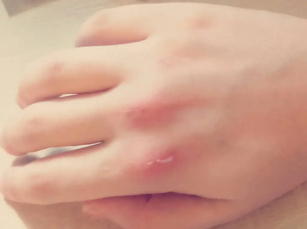 먹토하면 손등에 생기는 흔적.jpg | 인스티즈