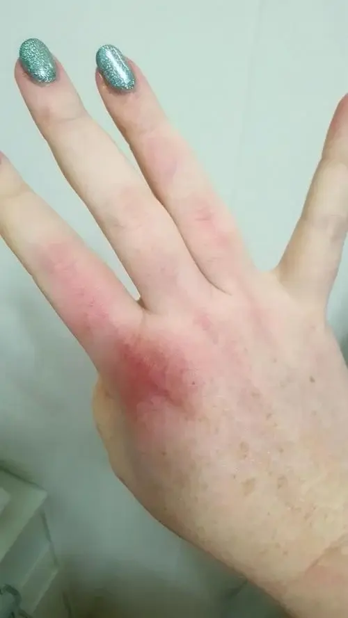 먹토하면 손등에 생기는 흔적.jpg | 인스티즈