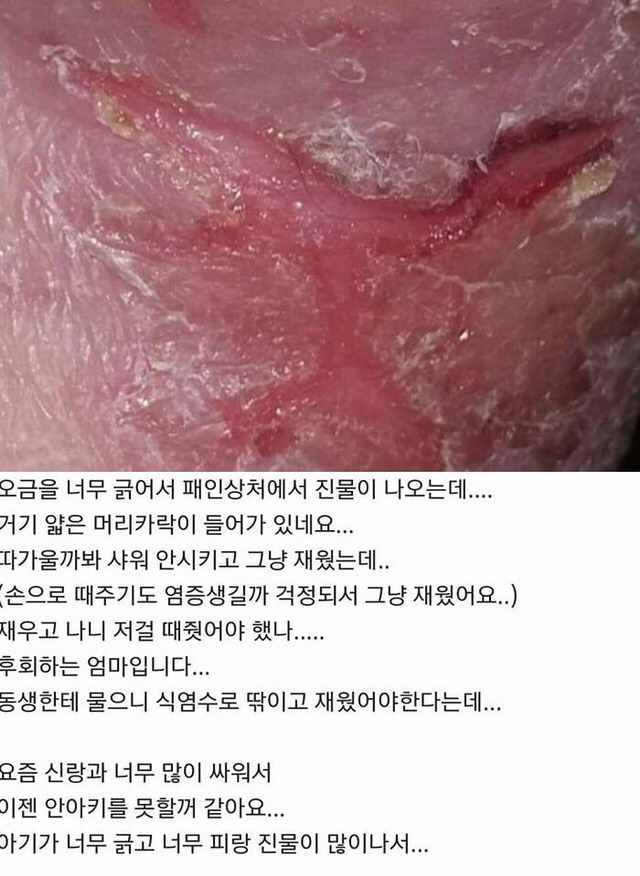 아기 약 안먹이고 자연 치유 시키는 안아키 라는 카페.jpg (혐오주의) | 인스티즈