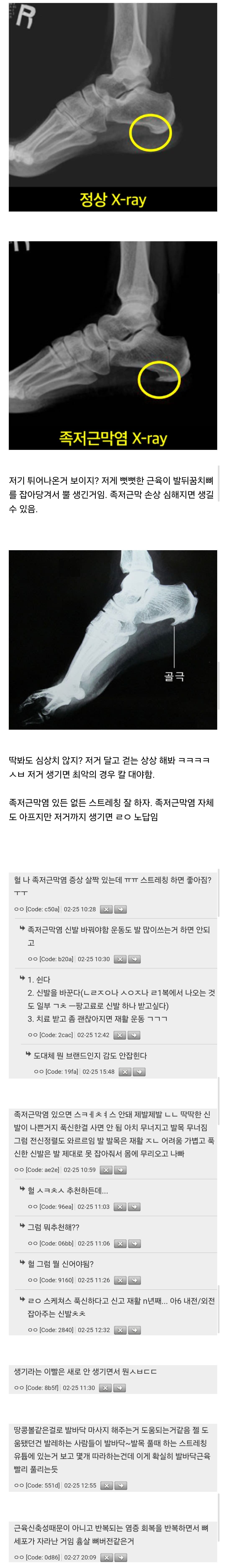 족저근막염 내버려두면 발바닥에 뿔도 생김 | 인스티즈