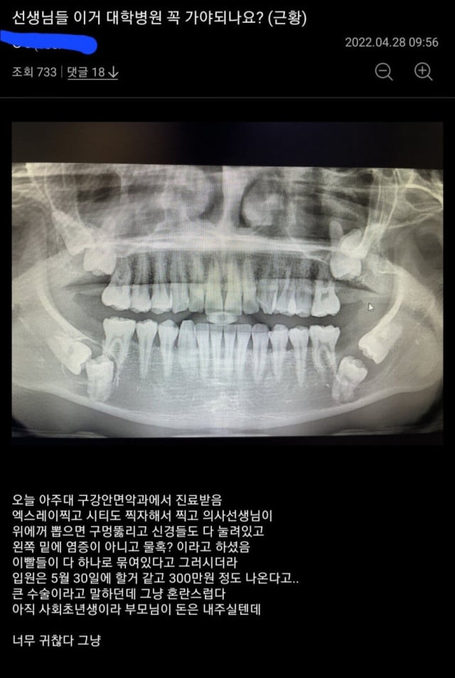 매복사랑니 레전드 그리고 병원 후기 | 인스티즈