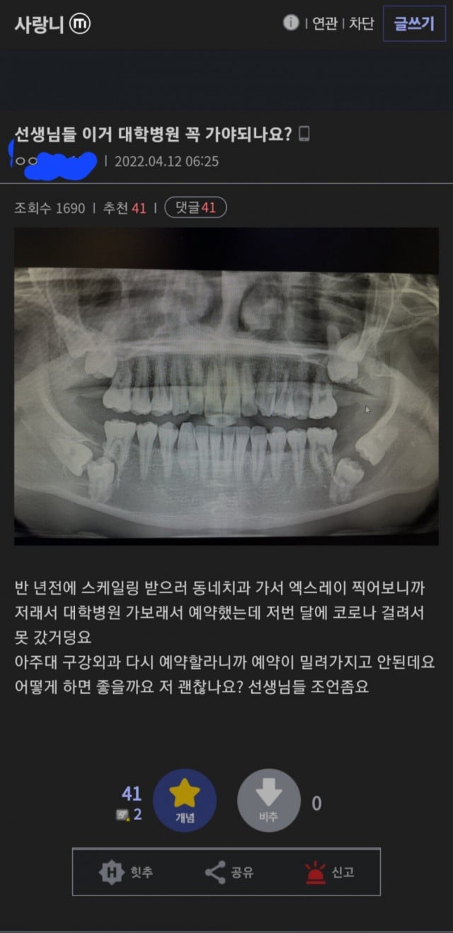 매복사랑니 레전드 그리고 병원 후기 | 인스티즈