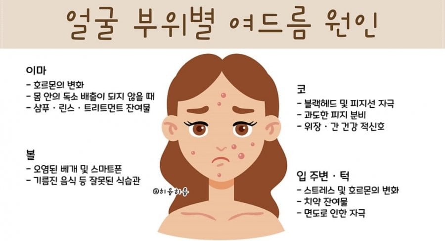 여드름 부위별 원인 | 인스티즈