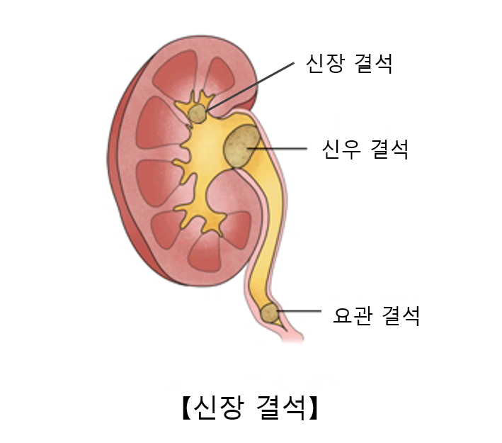 요로결석에 가려져있는 질병 | 인스티즈