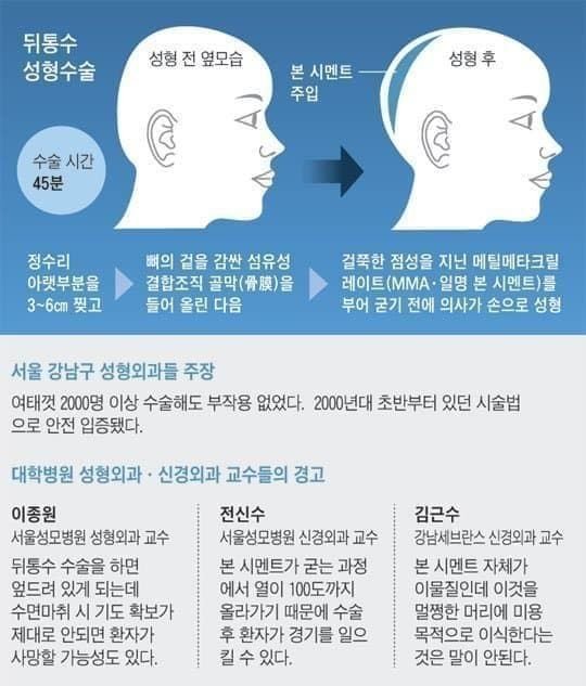 성형기술의 발전 | 인스티즈